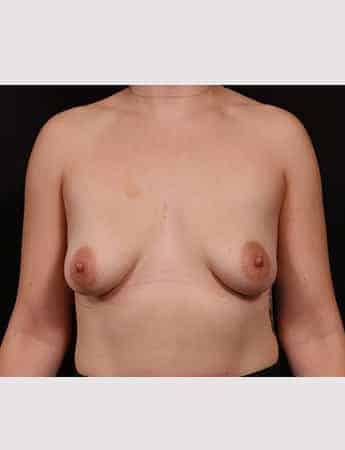 Before Image: Breast Augmentation with Peri Areolar Lift - front
