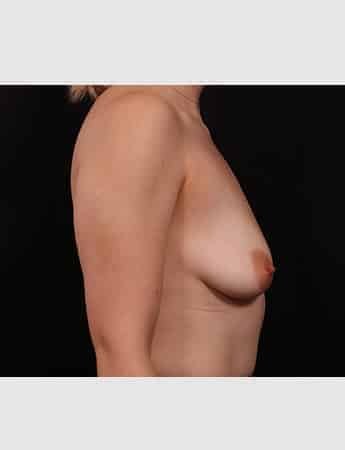 Before Image: Breast Augmentation with Peri Areolar Lift - right-side