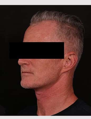 After Image: Neck Lift - left-front-oblique