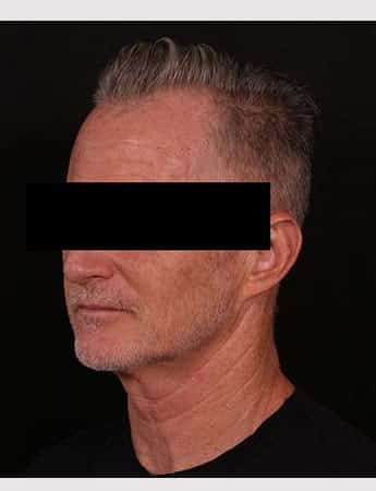 Before Image: Neck Lift - left-front-oblique
