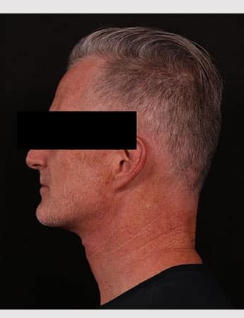 After Image: Neck Lift - left-side
