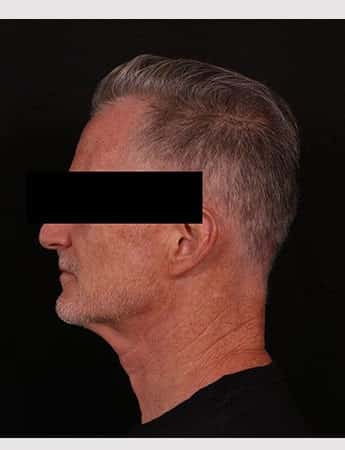 Before Image: Neck Lift - left-side