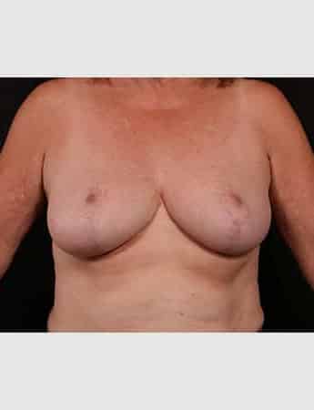 After Image: Breast Reduction - front