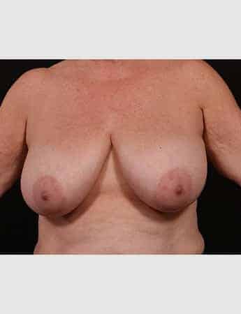 Before Image: Breast Reduction - front