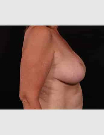 After Image: Breast Reduction - right-side