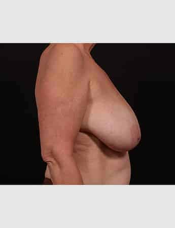 Before Image: Breast Reduction - right-side