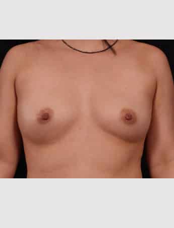 Before Image: Breast Augmentation - front