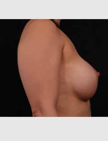 After Image: Breast Augmentation - right-side
