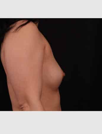 Before Image: Breast Augmentation - right-side