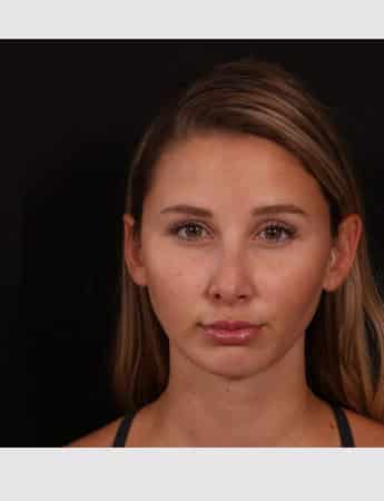 After Image: Chin implant, Neck liposuction, Buccal fat and Lip lift - front
