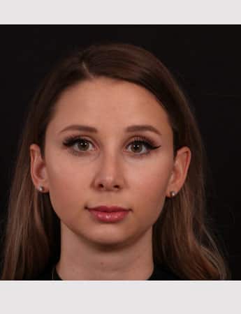 Before Image: Chin implant, Neck liposuction, Buccal fat and Lip lift - front
