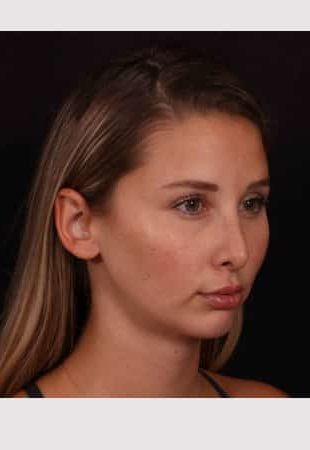 After Image: Chin implant, Neck liposuction, Buccal fat and Lip lift - right-front-oblique