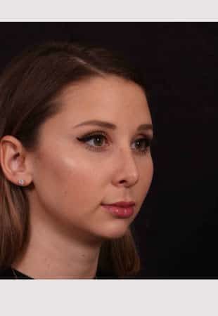 Before Image: Chin implant, Neck liposuction, Buccal fat and Lip lift - right-front-oblique