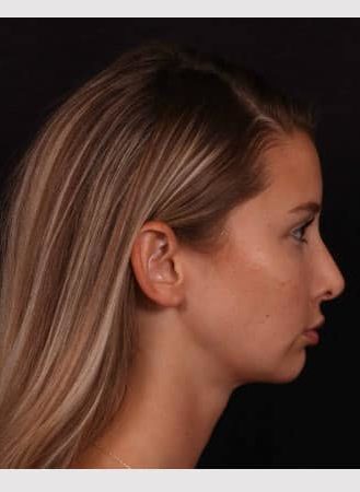 After Image: Chin implant, Neck liposuction, Buccal fat and Lip lift - right-side