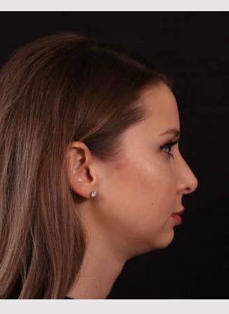 Before Image: Chin implant, Neck liposuction, Buccal fat and Lip lift - right-side