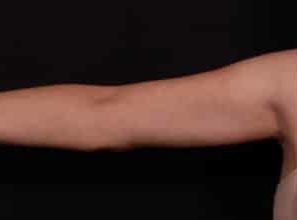 After Image: Brachioplasty - front