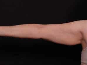 Before Image: Brachioplasty - front