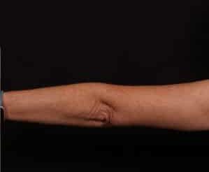 After Image: Brachioplasty - back