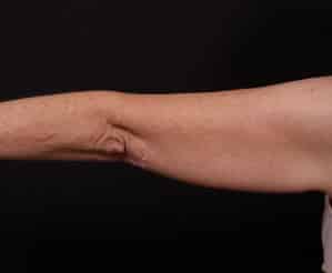 Before Image: Brachioplasty - back