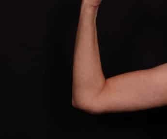 After Image: Brachioplasty - front
