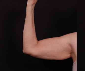 Before Image: Brachioplasty - front