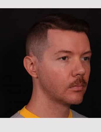 After Image: Chin Implant - right-front-oblique