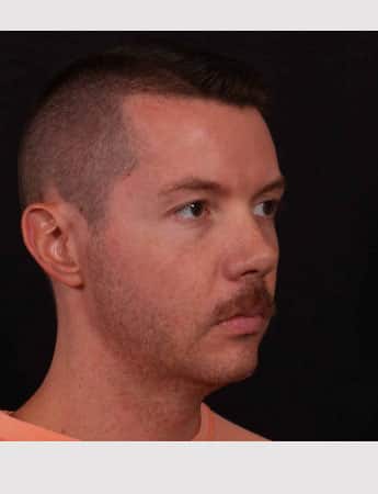Before Image: Chin Implant - right-front-oblique