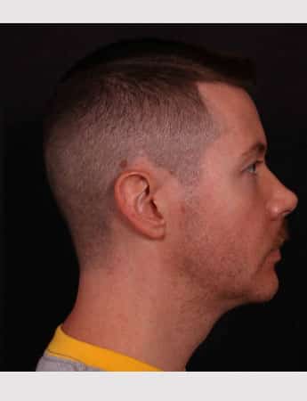 After Image: Chin Implant - right-side
