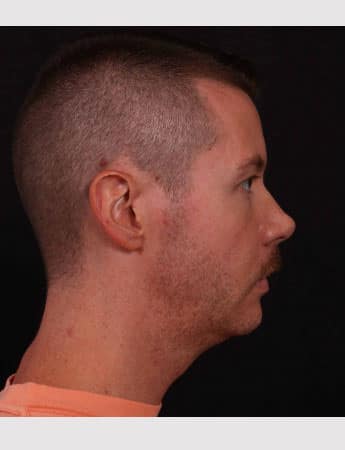 Before Image: Chin Implant - right-side