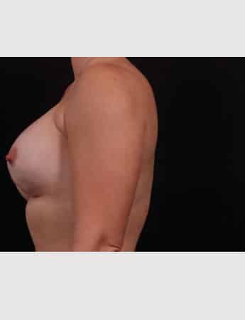Before Image: Secondary Breast Enhancement - left-side