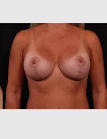 After Image: Secondary Breast Enhancement - front