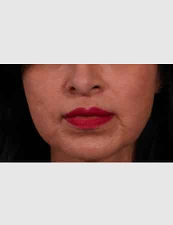 After Image: Lip Lift - front