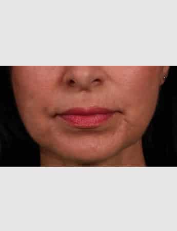 Before Image: Lip Lift - front