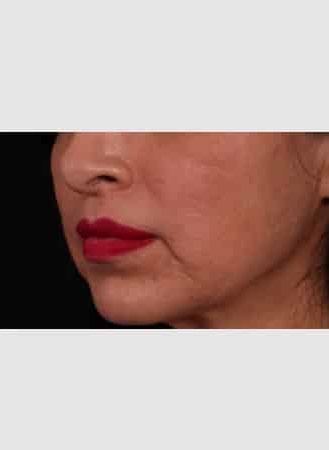 After Image: Lip Lift - left-front-oblique