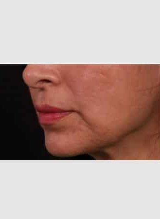 Before Image: Lip Lift - left-front-oblique