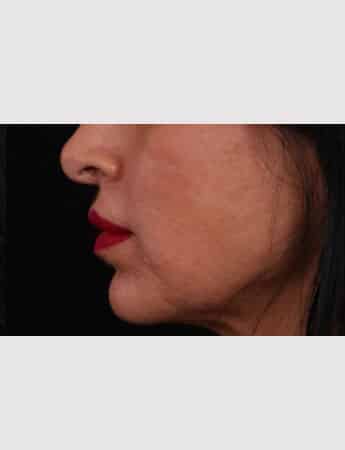 After Image: Lip Lift - left-side