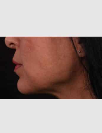 Before Image: Lip Lift - left-side