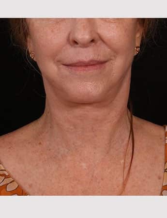 After Image: Lower Facelift - front
