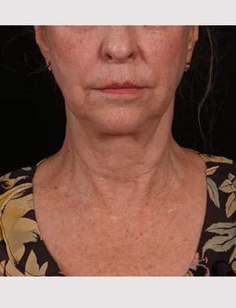 Before Image: Lower Facelift - front