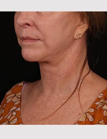 After Image: Lower Facelift - left-front-oblique