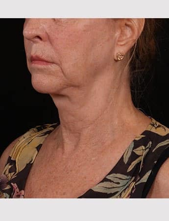 Before Image: Lower Facelift - left-front-oblique