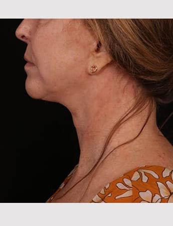 After Image: Lower Facelift - left-side