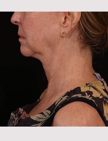 Before Image: Lower Facelift - left-side