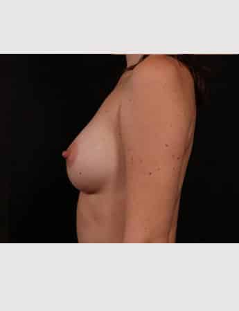 After Image: Breast Augmentation - left-side