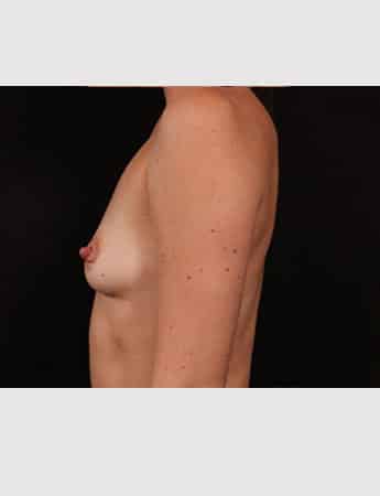 Before Image: Breast Augmentation - left-side