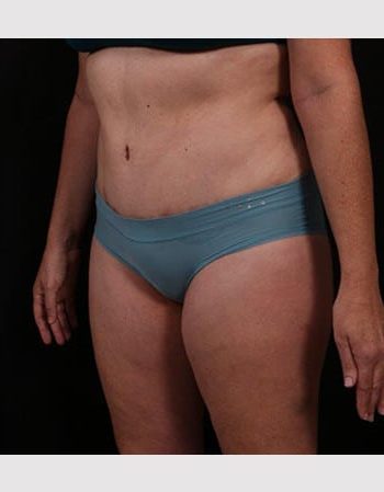 After Image: Tummy Tuck (Abdominoplasty) - left-front-oblique