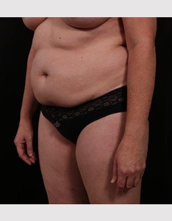 Before Image: Tummy Tuck (Abdominoplasty) - left-front-oblique