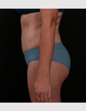 After Image: Tummy Tuck (Abdominoplasty) - left-side