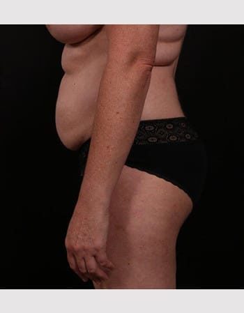 Before Image: Tummy Tuck (Abdominoplasty) - left-side