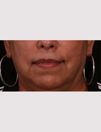 After Image: Lip Lift And Diamond Procedure - front